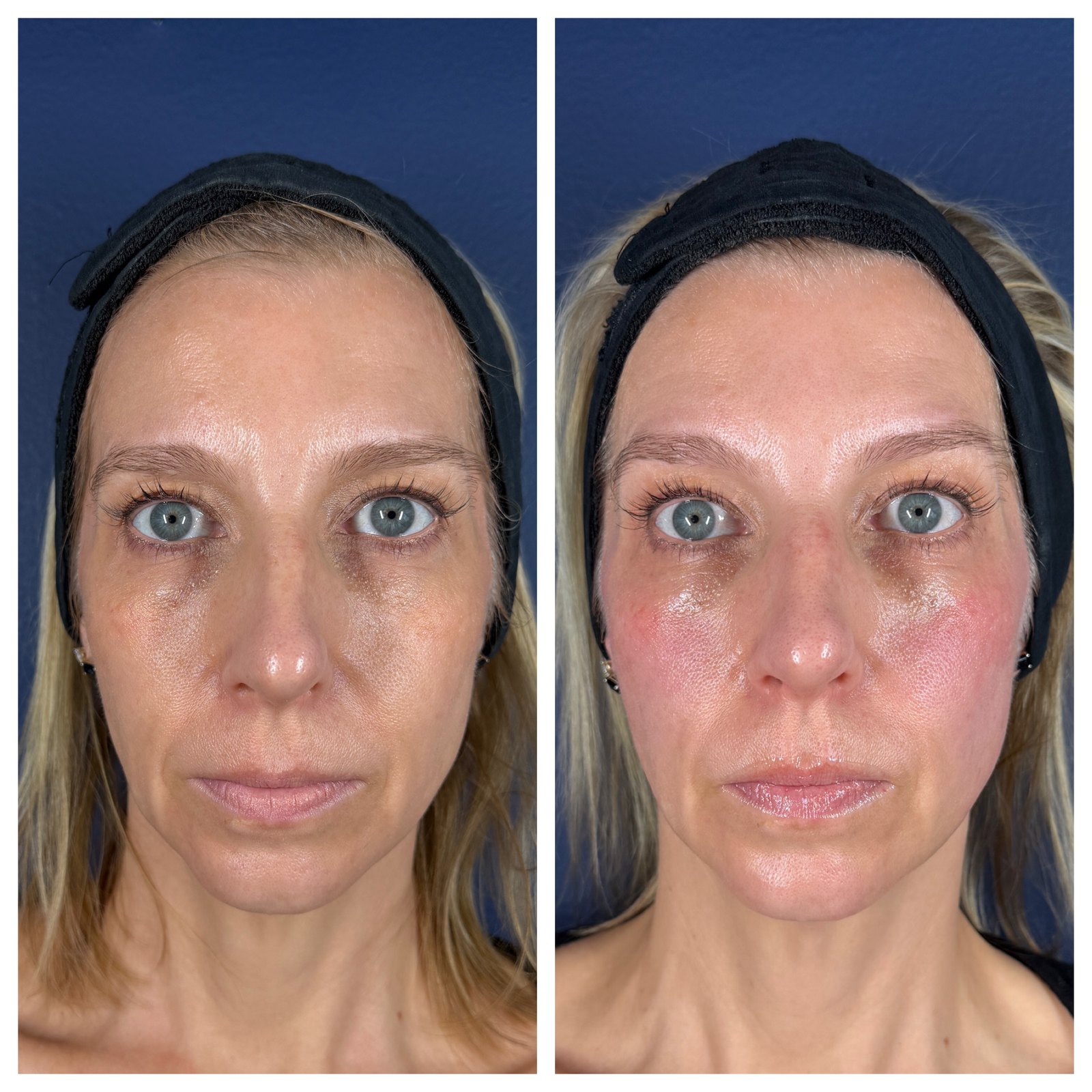XERF before and after — before on the left, immediately after treatment on the right