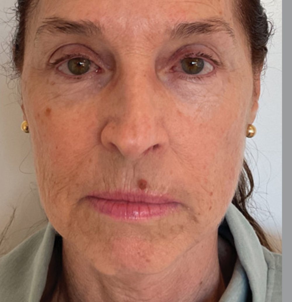 XERF lower-face and jawline, one treatment — after