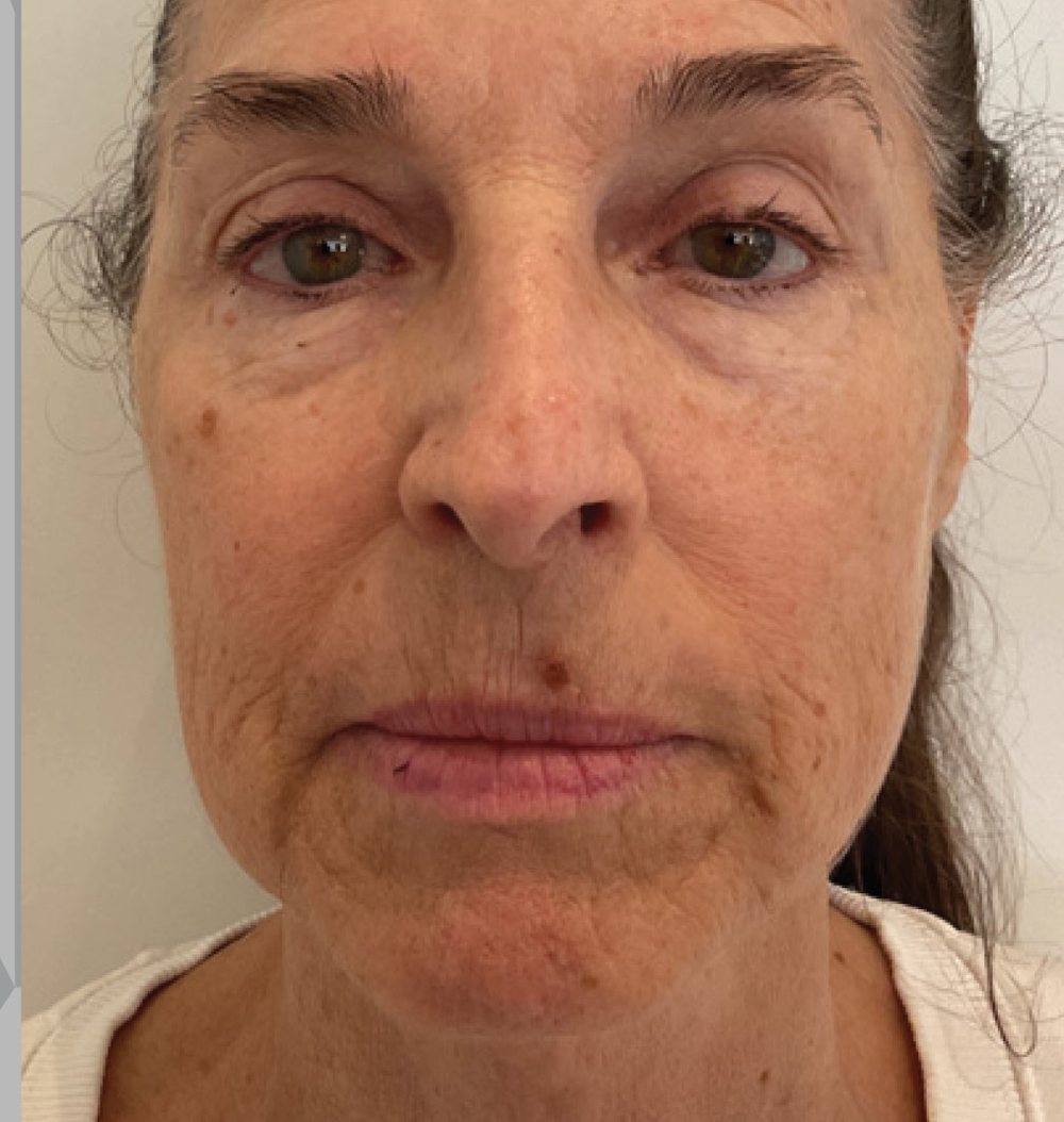 XERF lower-face and jawline, one treatment — before